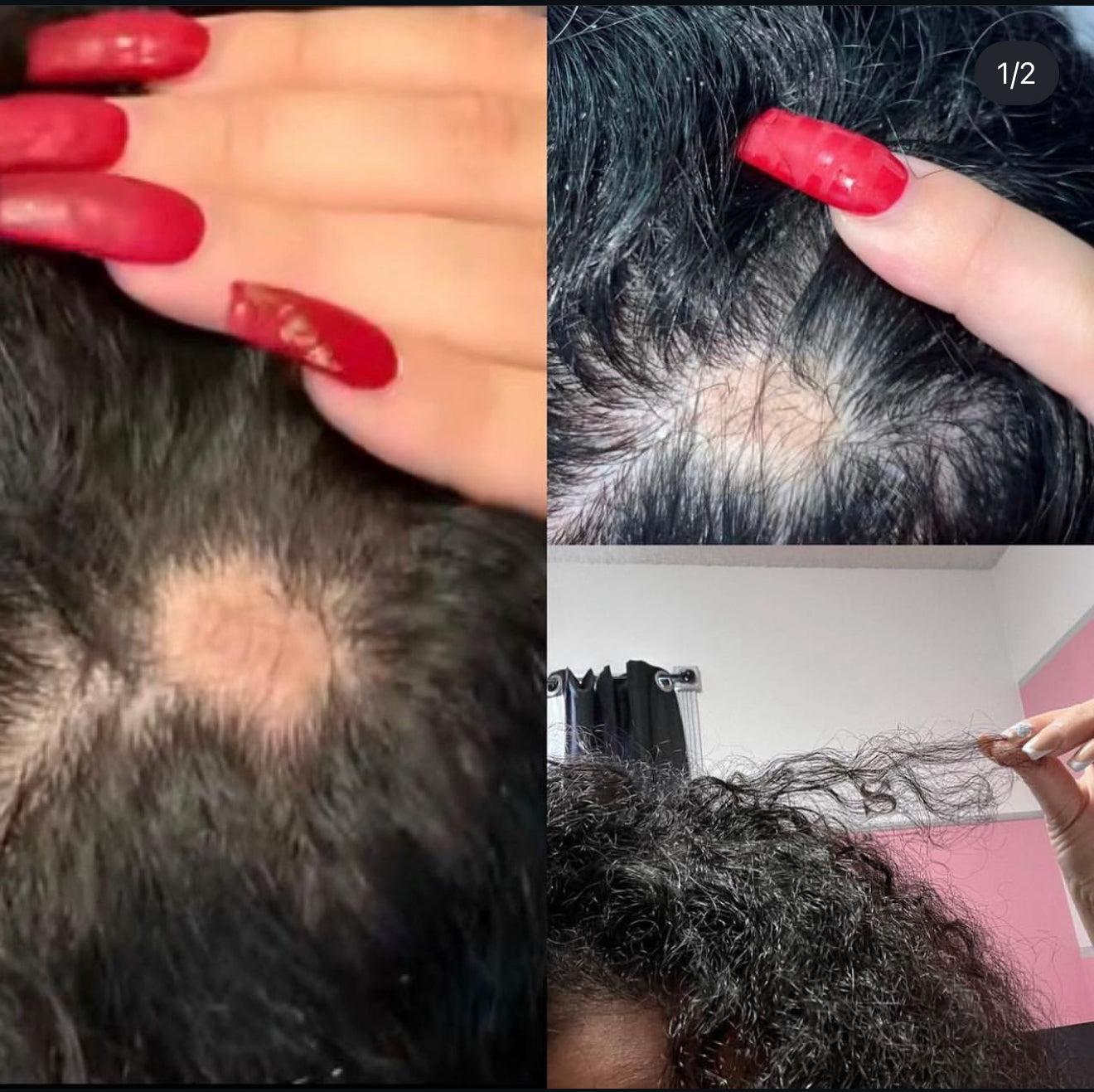 Before and after alopecia hair growth results using organic Rosemary Neem Oil showing scalp repair, hair regrowth, strengthened strands, and thinning hair recovery.